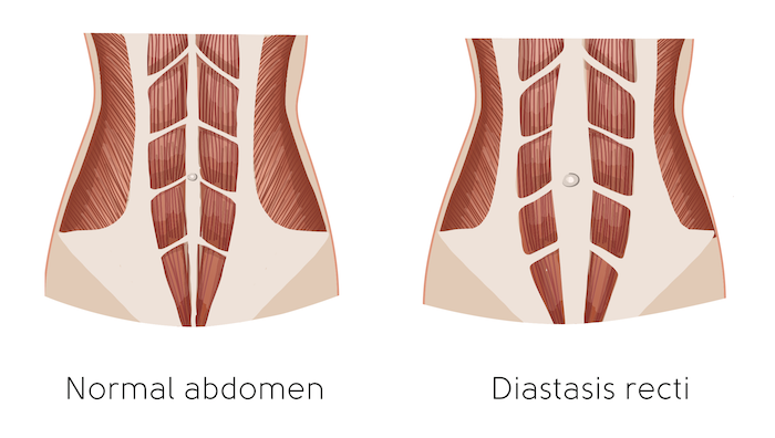 Understanding Abs Muscle Separation (Diastasis Recti) Postpartum